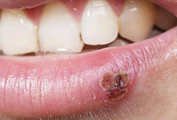 2024年生殖器皰疹攻克進(jìn)展,連貫性方法執(zhí)行評(píng)估_VFL27.121便攜版