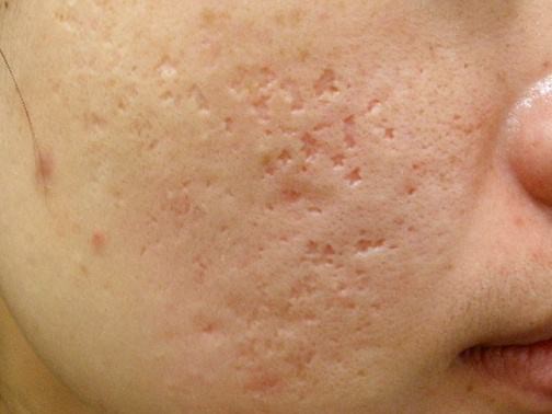 最新痘坑撫平神器，科技重塑肌膚之美，自信生活從此開始