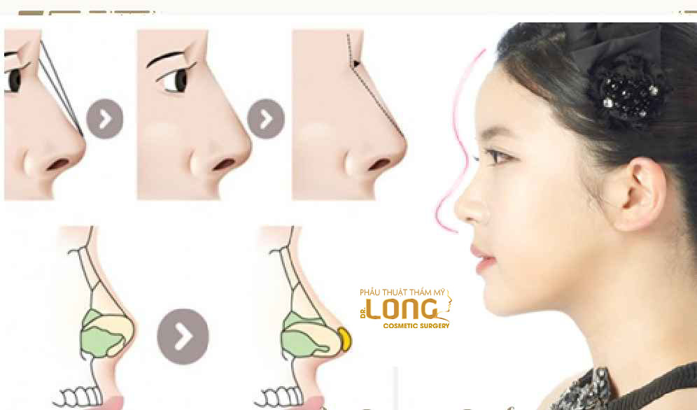 最新鼻整形技術(shù)重塑自信，煥發(fā)新生之美