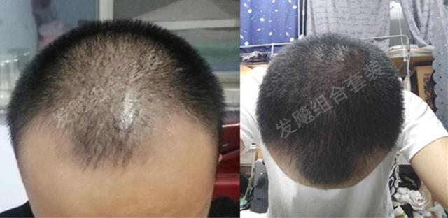 治愈脫發(fā)最新重大突破，重塑自信，希望之光再現(xiàn)