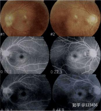 最新藥肺炎詳解，你需要知道的一切——健康小紅書